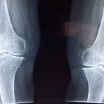 The Power of Magnets in Osteoarthritis Treatment